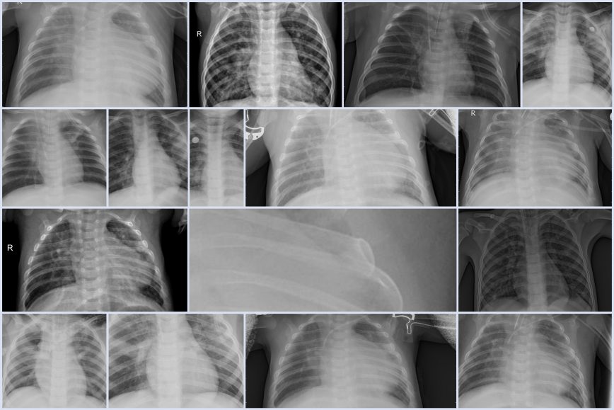 Diagnosing Pneumonia in X-Rays with Machine Learning